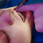 Braces